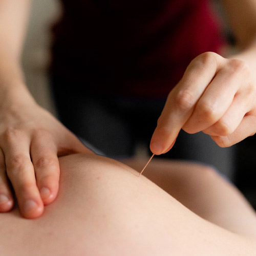 Dry Needling