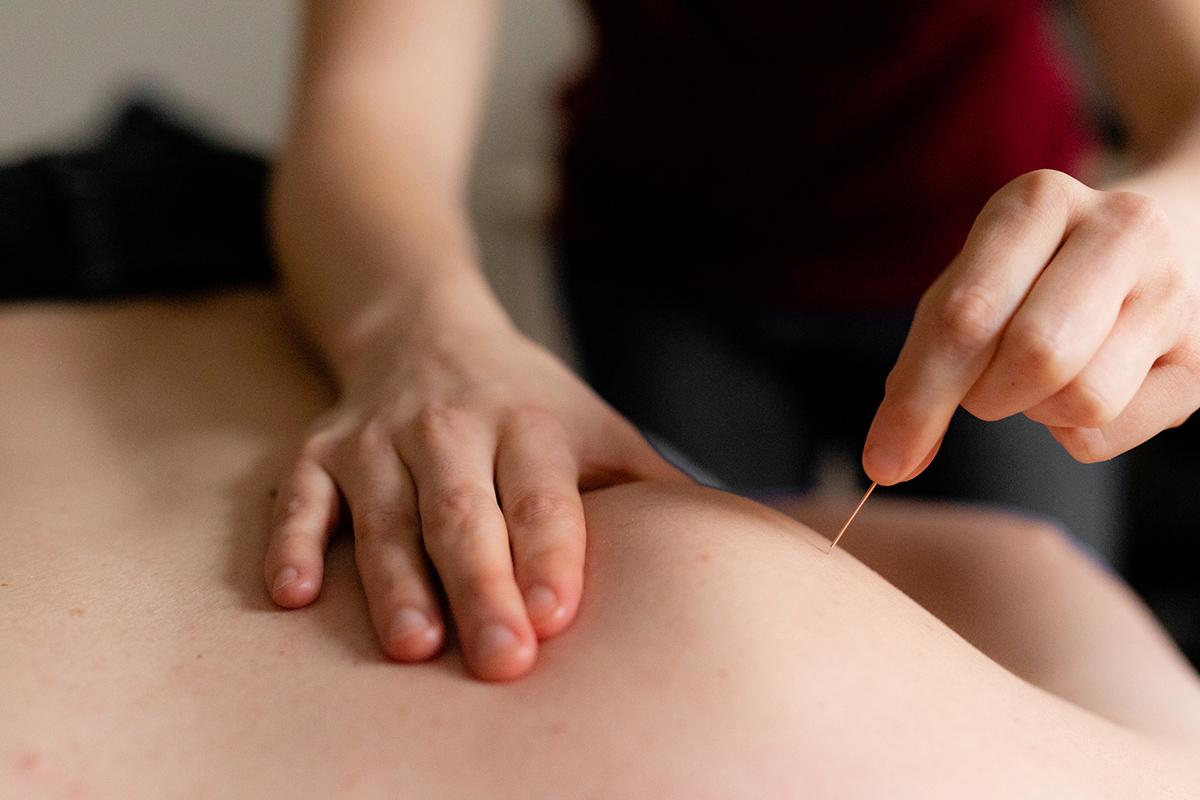 Dry Needling